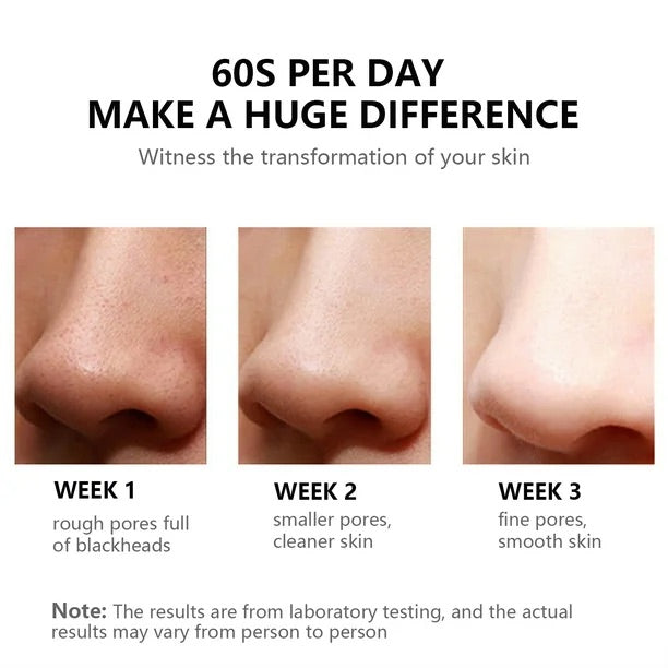 blackhead removal progression using ClearView™ vacuum on a nose.