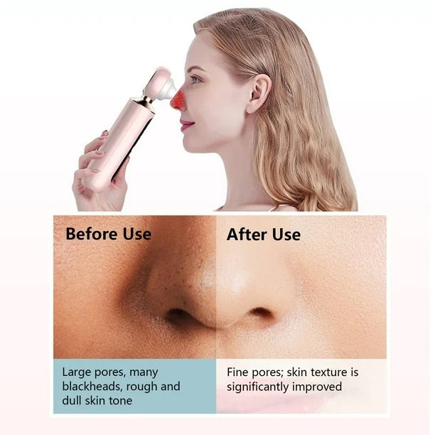 ClearView™ - Pore Vacuum with Magnifying Lens