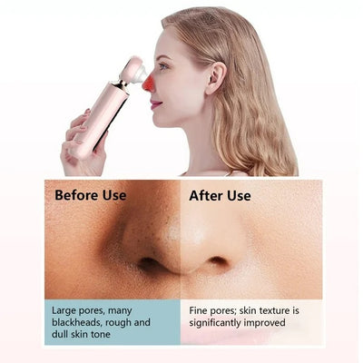 ClearView™ - Pore Vacuum with Magnifying Lens